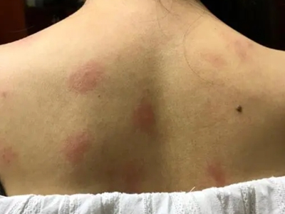蠓蟲叮咬背上有紅色斑塊圖