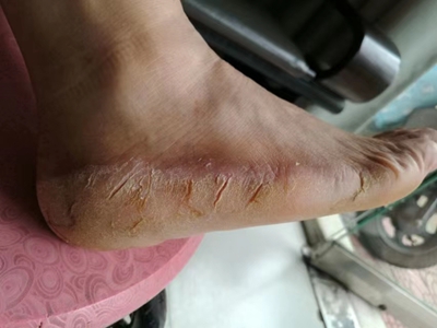 手足皸裂腳部有許多皸裂圖