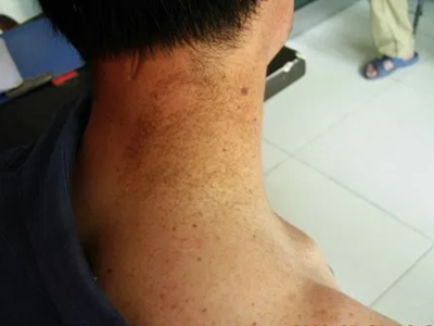 雀斑樣痣頸部長一大片褐色的斑點圖