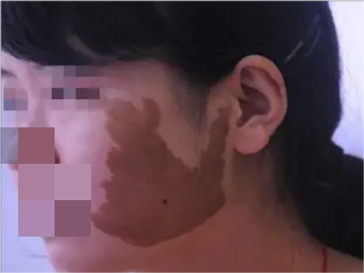 咖啡斑臉上有不規則的深咖啡色斑圖