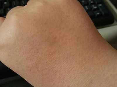 網狀肢端色素沉著手背粗糙有斑點圖 網狀肢端色素沉著手背粗糙有斑點圖