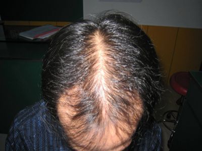 男性型脫髮頭髮稀發縫粗大圖