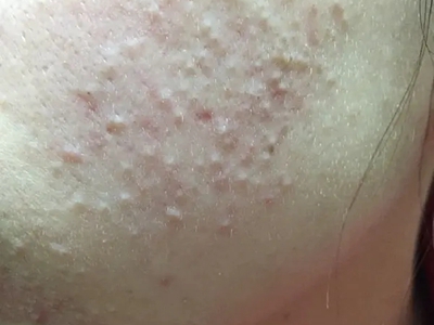 化妝品性痤瘡面部長白頭粉刺圖