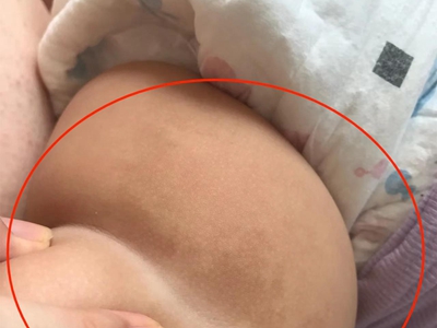 咖啡斑大腿周圍有淺咖啡色的斑片圖 咖啡斑大腿周圍有淺咖啡色的斑片圖