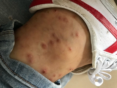 蠓蟲叮咬腳脖子上起了好多紅色丘疹圖 蠓蟲叮咬腳脖子上起了好多紅色丘疹圖