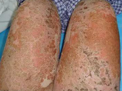 泛發性膿皰型銀屑病大腿大量結痂圖 泛發性膿皰型銀屑病大腿大量結痂圖