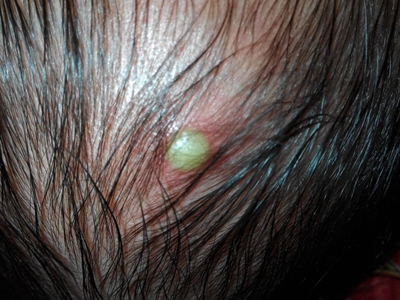 新生兒膿皰瘡頭皮有一個黃白色膿包圖 新生兒膿皰瘡頭皮有一個黃白色膿包圖