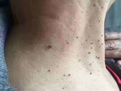 皮膚纖維瘤頸部有針尖大的小肉粒圖 皮膚纖維瘤頸部有針尖大的小肉粒圖
