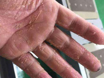 手部濕疹手掌顏色加深大面積脫皮圖