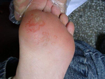 幼年跖部皮病腳掌發紅有圓形斑塊圖 幼年跖部皮病腳掌發紅有圓形斑塊圖