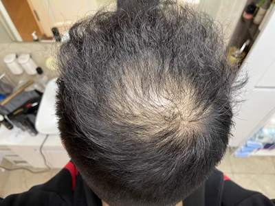 雄激素性脫髮頭頂有一塊頭髮減少圖 雄激素性脫髮頭頂有一塊頭髮減少圖