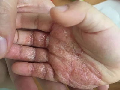 手部濕疹手掌有結痂脫屑圖
