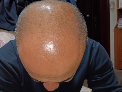 雄激素性脫髮頭頂脫髮還反光圖 雄激素性脫髮頭頂脫髮還反光圖