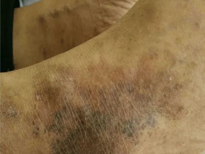 煙酸缺乏症腳踝皮膚粗糙長黑斑圖