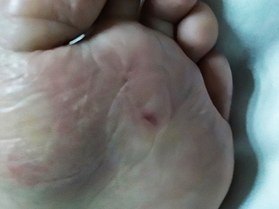 幼年跖部皮病腳底有紅斑裂紋圖 幼年跖部皮病腳底有紅斑裂紋圖