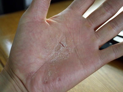 手部濕疹手掌有一個橫向裂紋圖 手部濕疹手掌有一個橫向裂紋圖