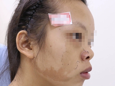 咖啡斑臉上有不規則的咖啡色斑圖