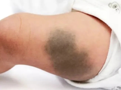 伊藤痣大腿部大面積烏青色斑圖