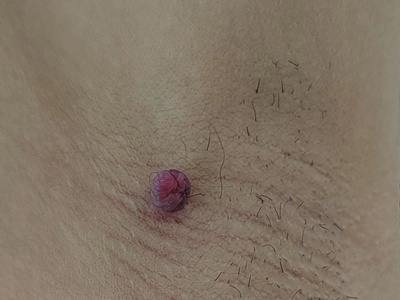 皮膚纖維瘤腋下紫紅色肉球圖