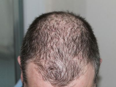 男性型脫髮頭髮稀疏頭皮發紅圖 男性型脫髮頭髮稀疏頭皮發紅圖