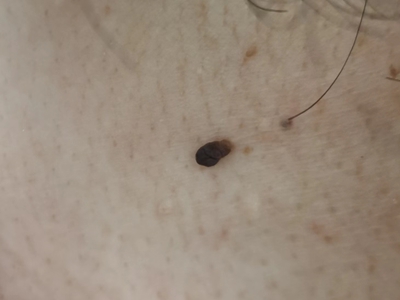 皮膚纖維瘤頸部長了一個黑疙瘩圖 皮膚纖維瘤頸部長了一個黑疙瘩圖