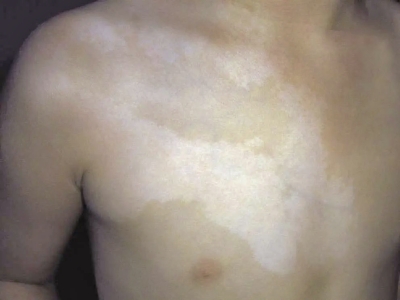 脫色素性痣胸上有條狀白斑圖 脫色素性痣胸上有條狀白斑圖