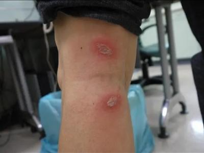 蠓蟲叮咬小腿後邊有潰爛圖 蠓蟲叮咬小腿後邊有潰爛圖
