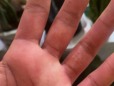 手部濕疹左手手指內面紅腫圖 手部濕疹左手手指內面紅腫圖