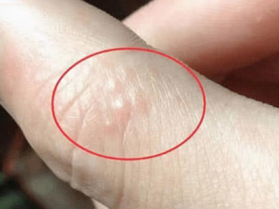 手部濕疹手指上有幾個凸起的小疙瘩圖 手部濕疹手指上有幾個凸起的小疙瘩圖