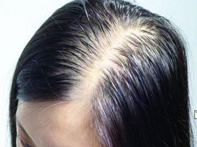 女性型脫髮頭頂頭髮稀疏發縫寬大圖 女性型脫髮頭頂頭髮稀疏發縫寬大圖