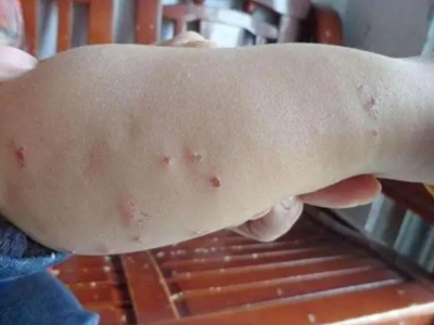 蠓蟲叮咬胳膊上疙瘩抓破結痂圖 蠓蟲叮咬胳膊上疙瘩抓破結痂圖