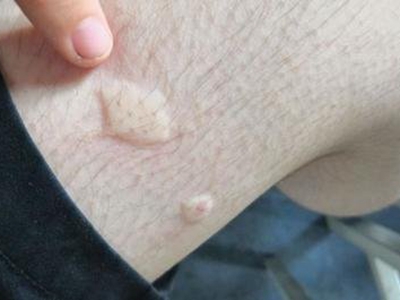 蚊子叮咬大腿起風團疙瘩圖
