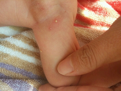 新生兒膿皰瘡腳上幾個散在小膿包圖 新生兒膿皰瘡腳上幾個散在小膿包圖