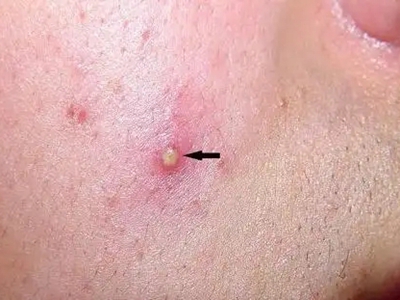 嗜酸性膿皰性毛囊炎面部黃色膿包圖 嗜酸性膿皰性毛囊炎面部黃色膿包圖