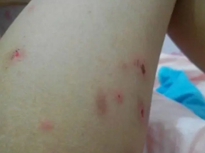 蠓蟲叮咬腿上疙瘩撓破後結紅痂圖