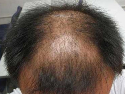 男性型脫髮頭上對稱性脫髮圖 男性型脫髮頭上對稱性脫髮圖