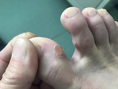 胼胝大腳趾兩邊有發硬的斑塊圖