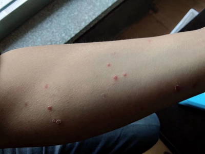 尋常型銀屑病胳膊上有紅點脫皮圖 尋常型銀屑病胳膊上有紅點脫皮圖