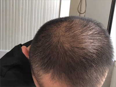 雄激素性脫髮頭頂頭髮稀疏減少圖