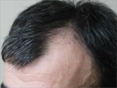 男性型脫髮前額呈M型脫髮圖 男性型脫髮前額呈M型脫髮圖