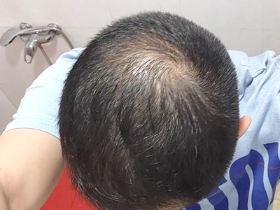 雄激素性脫髮頭頂頭髮稀疏露頭皮圖 雄激素性脫髮頭頂頭髮稀疏露頭皮圖