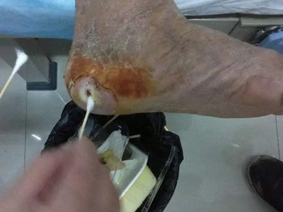 糖尿病性皮膚病腳後跟爛了一個洞圖 糖尿病性皮膚病腳後跟爛了一個洞圖