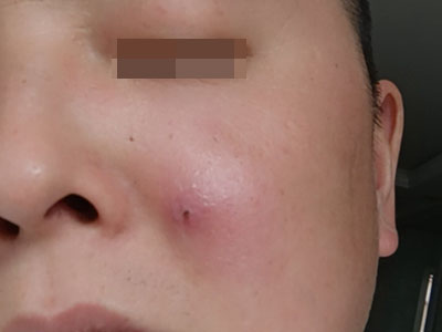 皮脂腺囊腫臉頰出現黑色小潰瘍圖