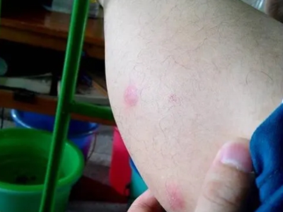 蠓蟲叮咬小腿有兩個紅疙瘩圖 蠓蟲叮咬小腿有兩個紅疙瘩圖