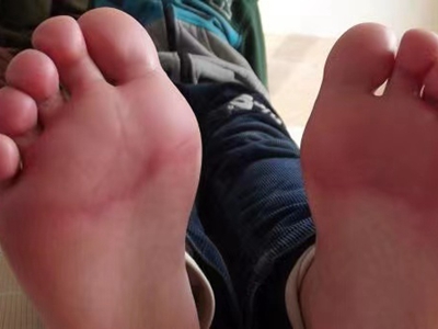 幼年跖部皮病腳底有大塊紅斑圖 幼年跖部皮病腳底有大塊紅斑圖