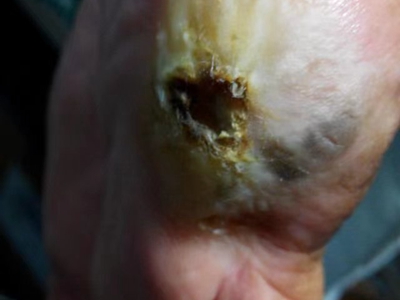 淺表播散型黑色素瘤腳底爛一個大坑圖 淺表播散型黑色素瘤腳底爛一個大坑圖