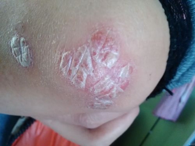 關節病型銀屑病肘部長紅斑起白皮圖 關節病型銀屑病肘部長紅斑起白皮圖