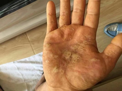 手部濕疹右側手掌長多個水皰圖