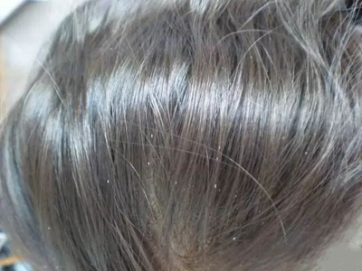毛髮管型頭髮上有白色管狀物附著圖