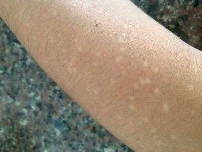 特發性滴狀色素減少症胳膊起白點圖